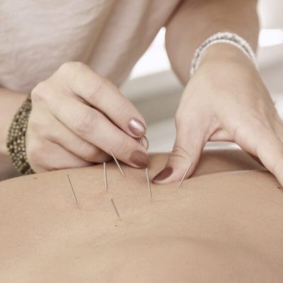 , Community Acupuncture