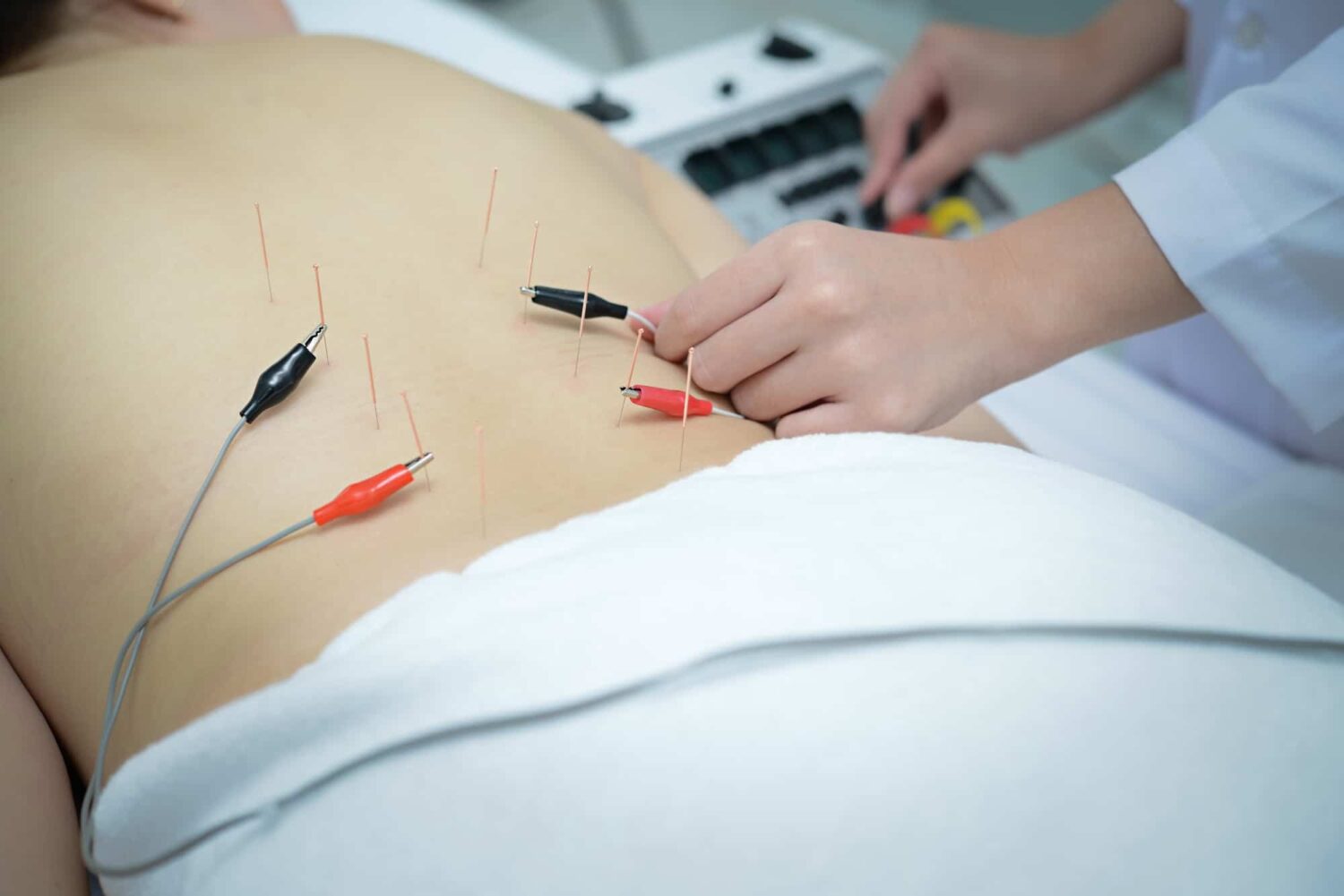 , Electroacupuncture Explained: Benefits, Risks, and Who Should Try It