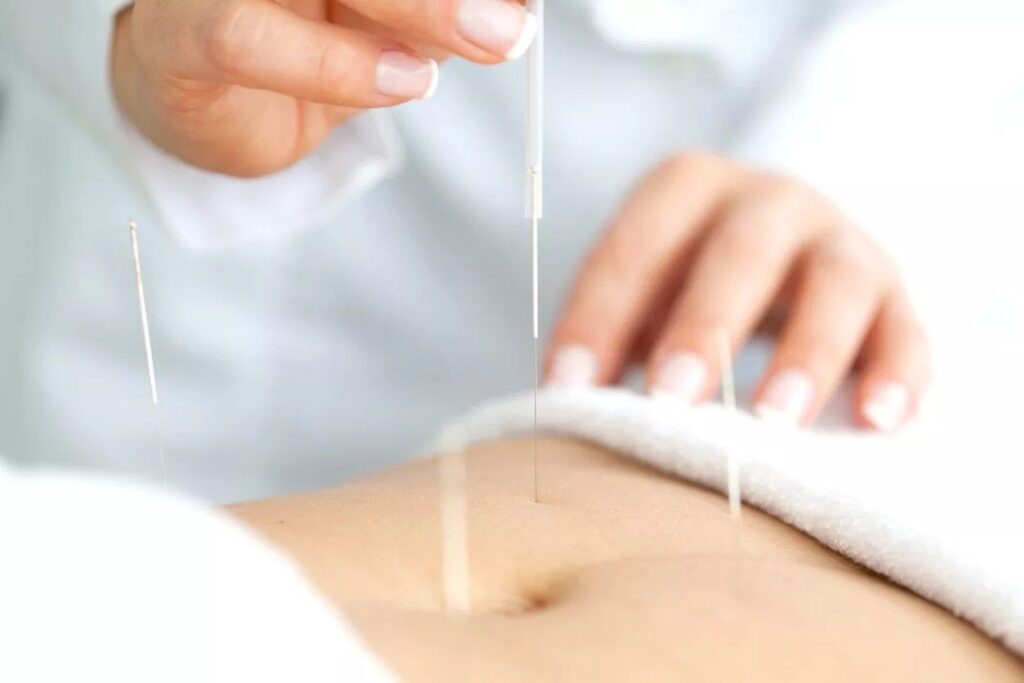 acupuncture for IVF support