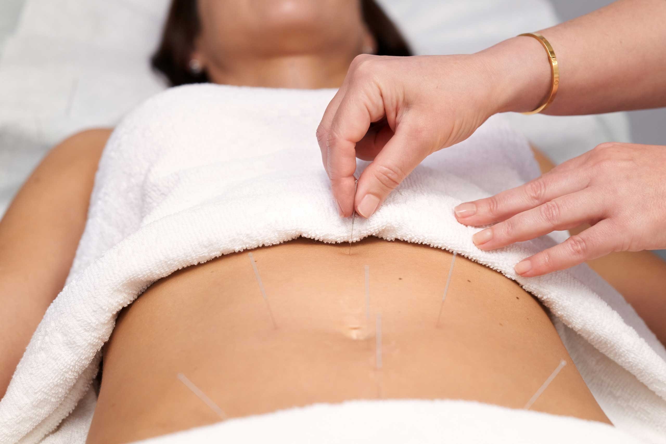 best fertility acupuncture NYC, Finding the Best Fertility Acupuncture in NYC: What to Look for and Why It Matters
