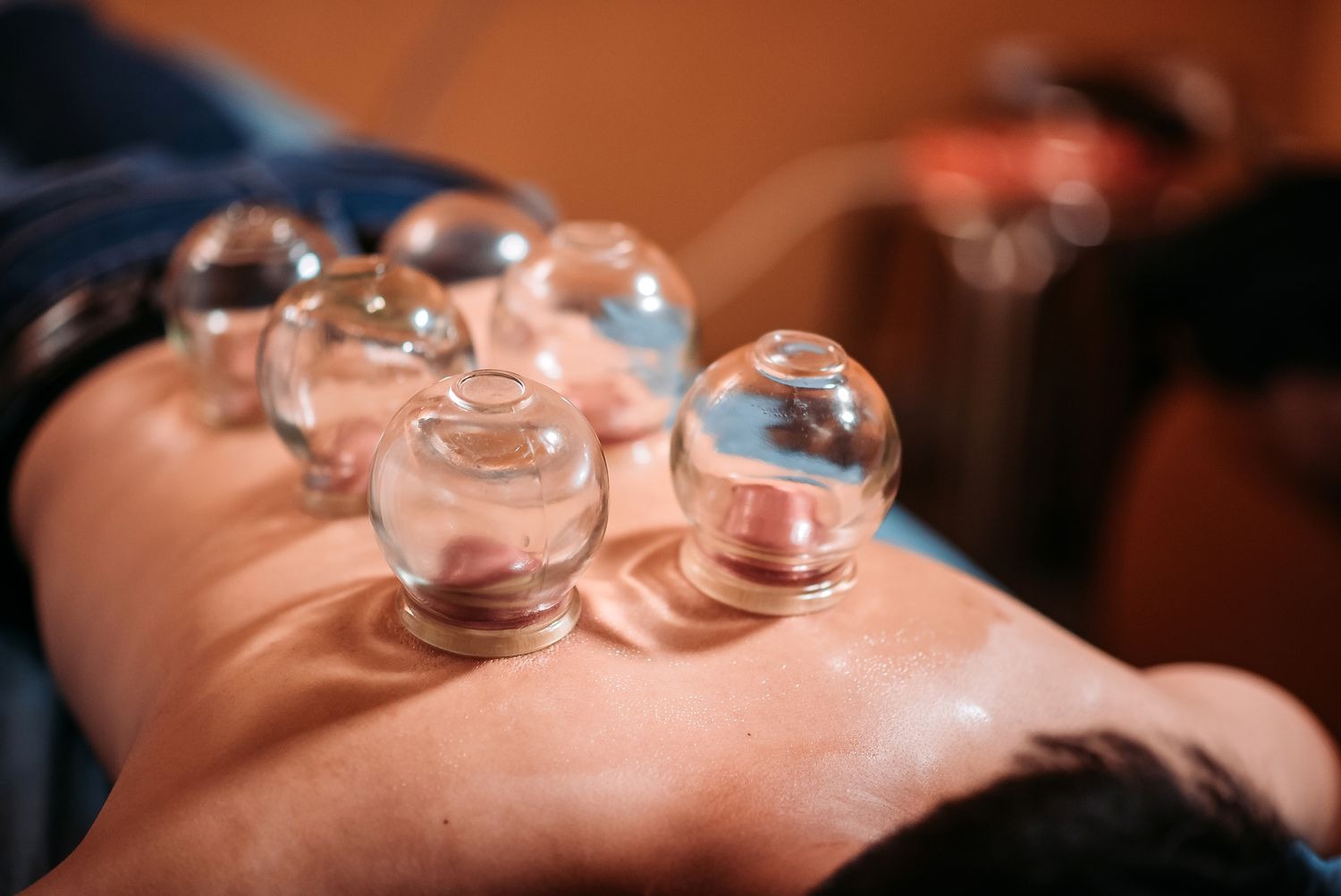 cupping therapy NYC, The Power of Cupping Therapy: How This Ancient Practice Can Relieve Pain and Promote Wellness in NYC