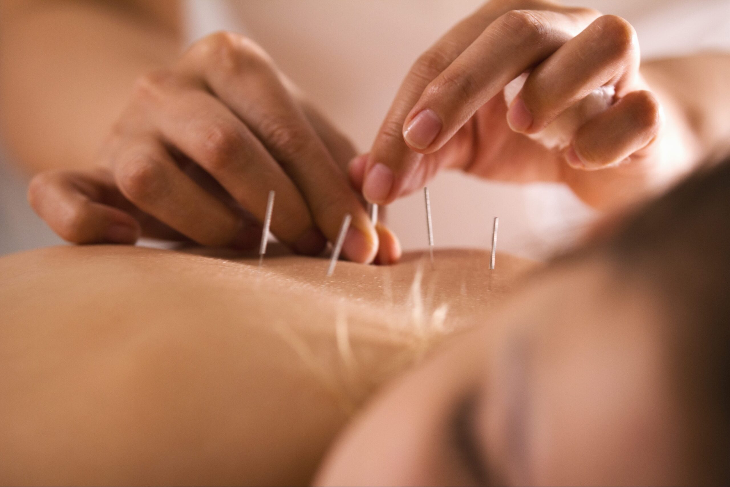 midtown acupuncture, Find Your Balance in the Heart of the City: The Benefits of Midtown Acupuncture for Busy New Yorkers