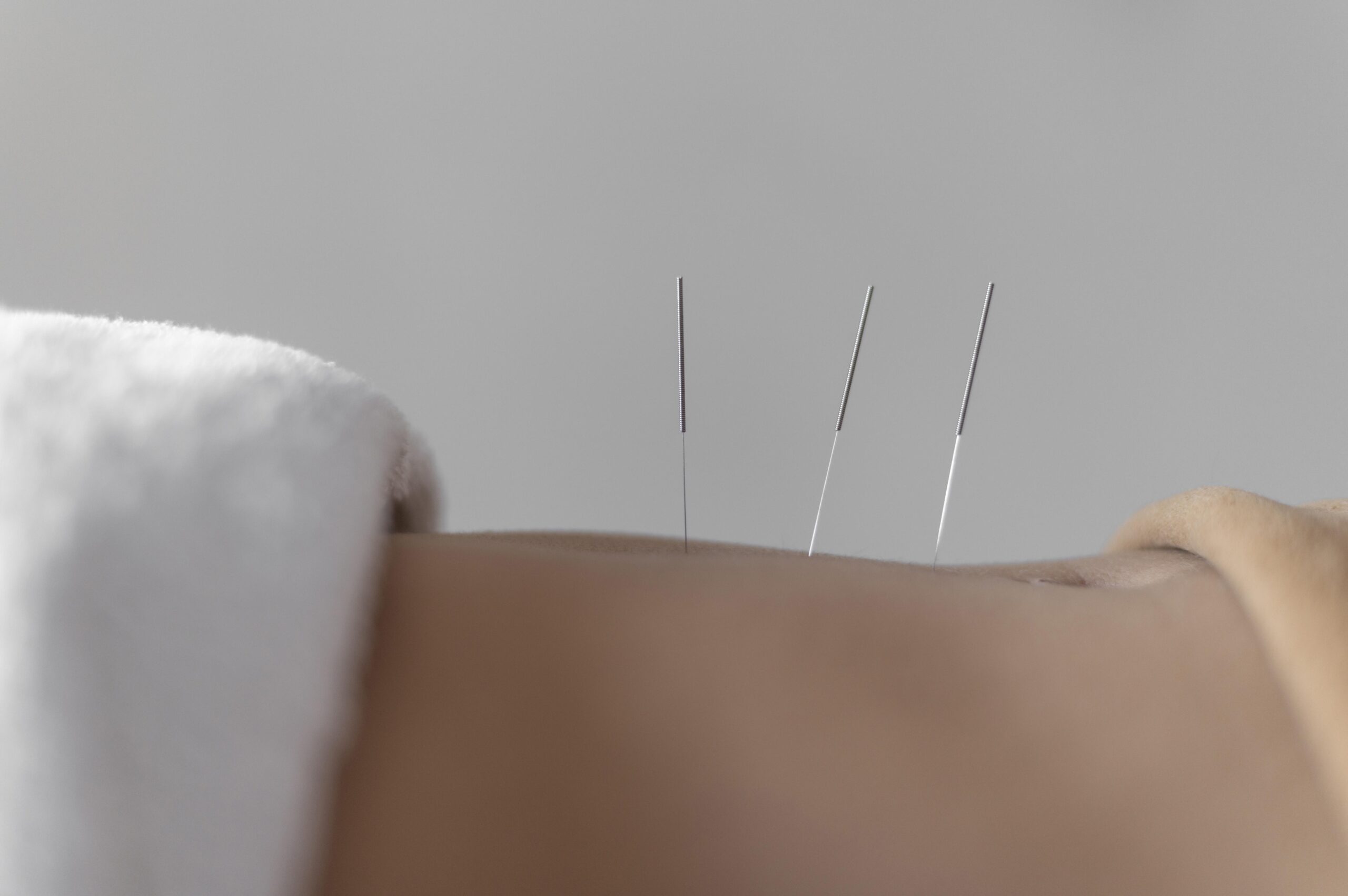 dry needling NYC, Understanding Trigger Point Release: A Closer Look at Muscle Pain and Dry Needling