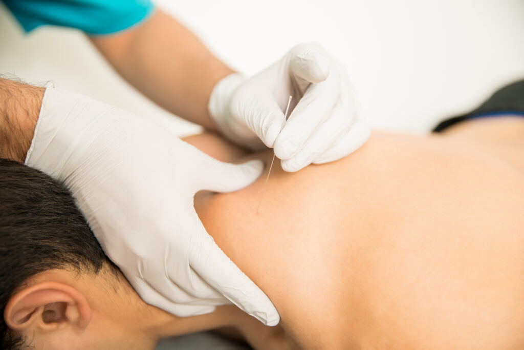 dry needling NYC