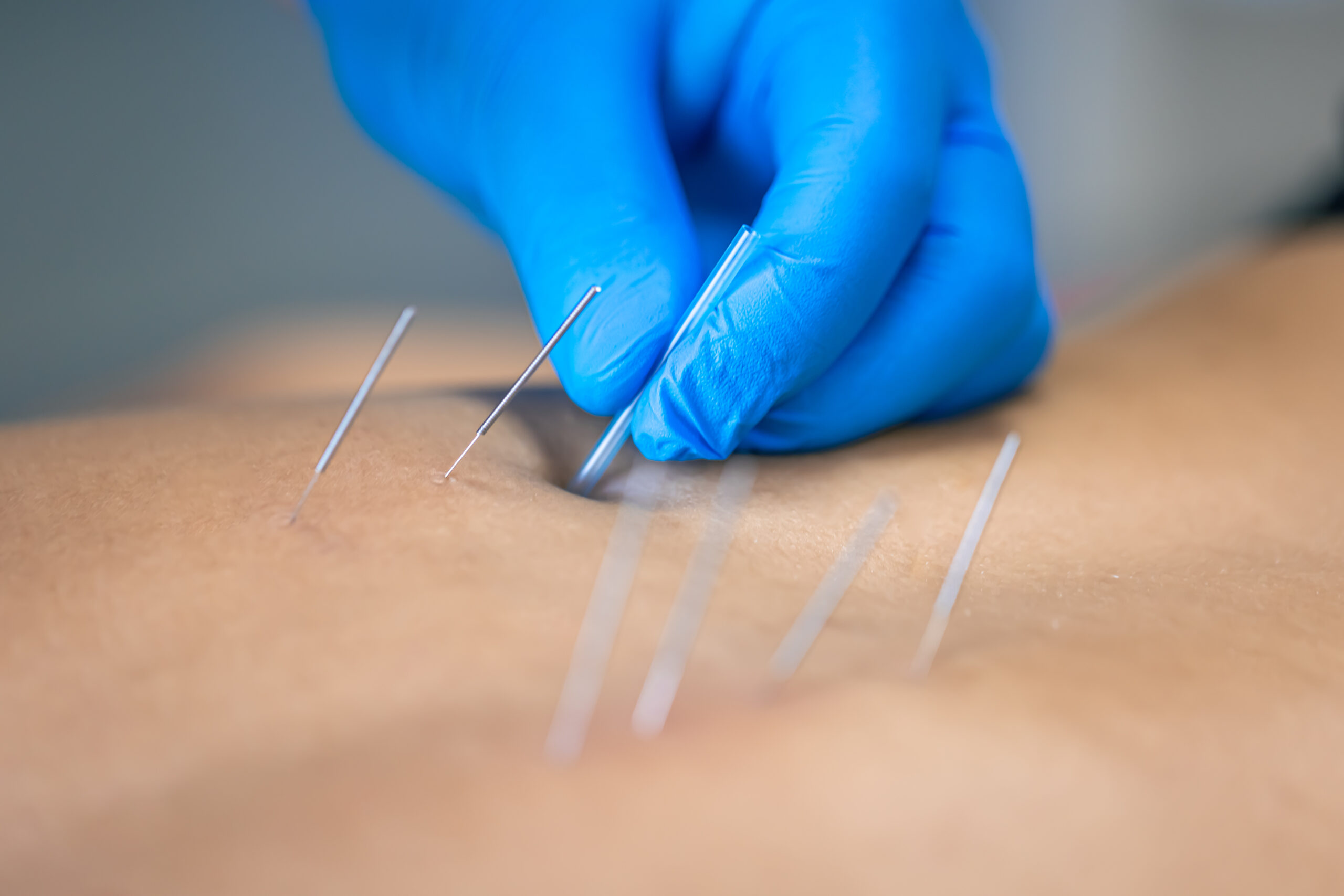 acupuncture therapy nyc, Bridging Modalities: Understanding the Role of Dry Needling and Microneedling in Modern Practice