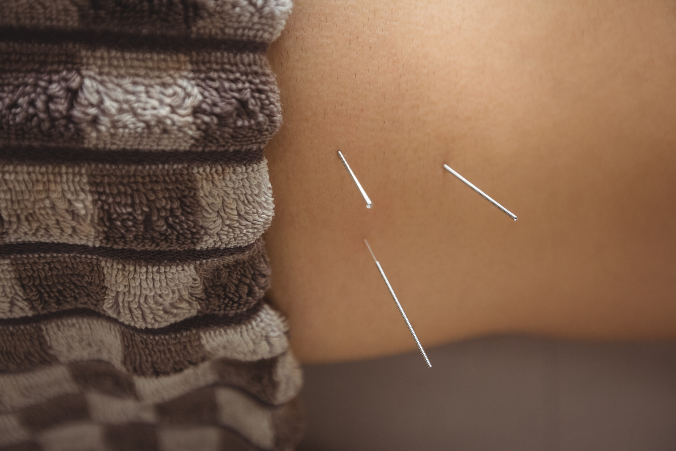 Acupuncture NYC, Is Acupuncture Right for You? How to Decide If It’s a Good Fit