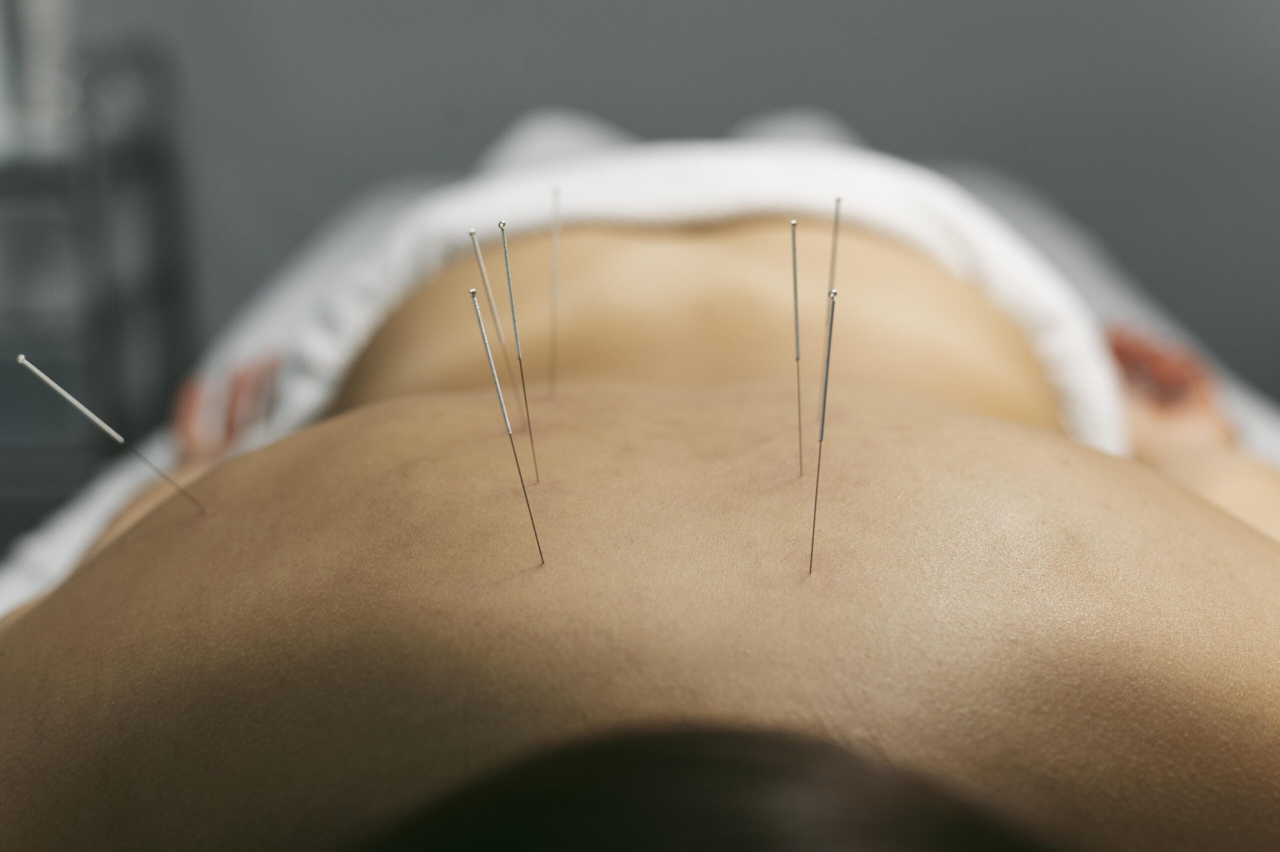 Acupuncture NYC, Acupuncture’s Expanding Role in NYC’s Modern Wellness Movement