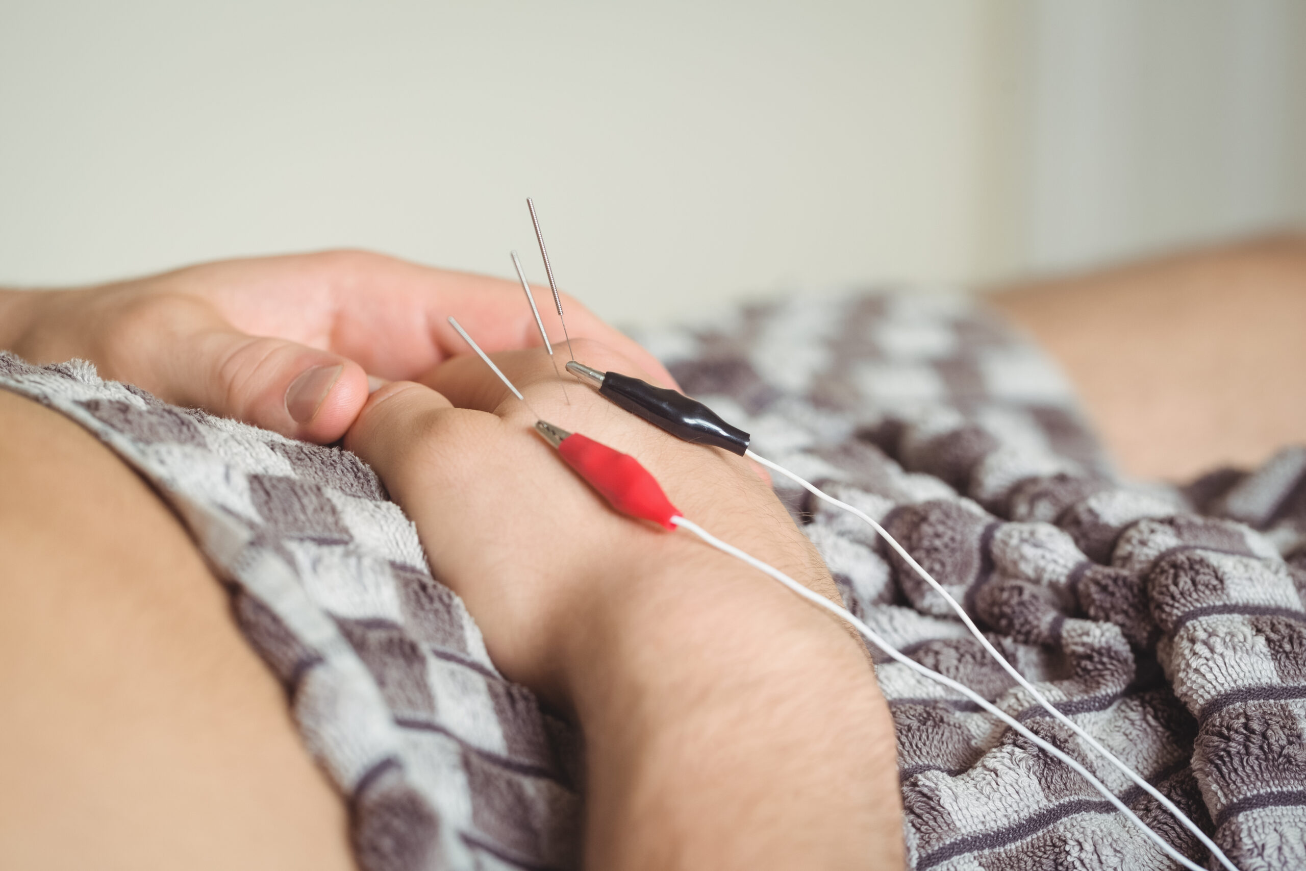 Electroacupuncture NYC, How Targeted Electrical Stimulation and Focused Fertility Acupuncture Work Together to Support IVF Treatment Plans in NYC