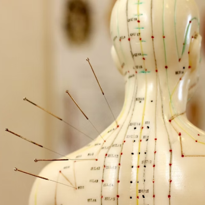 , Pain Management Acupuncture