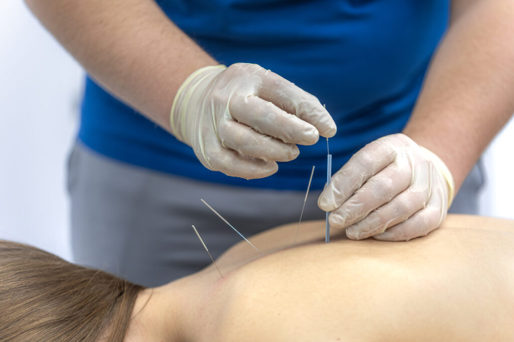 The Science Behind Acupuncture for Pain Relief—And Why More New Yorkers Are Trying It